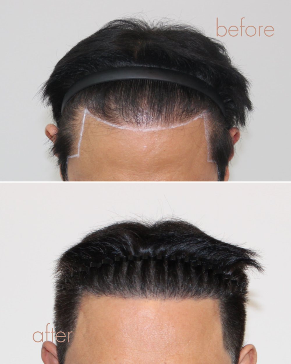 남성 헤어라인·M자 두피문신 전후 결과 | 안양 평촌 D.LAB SCALP