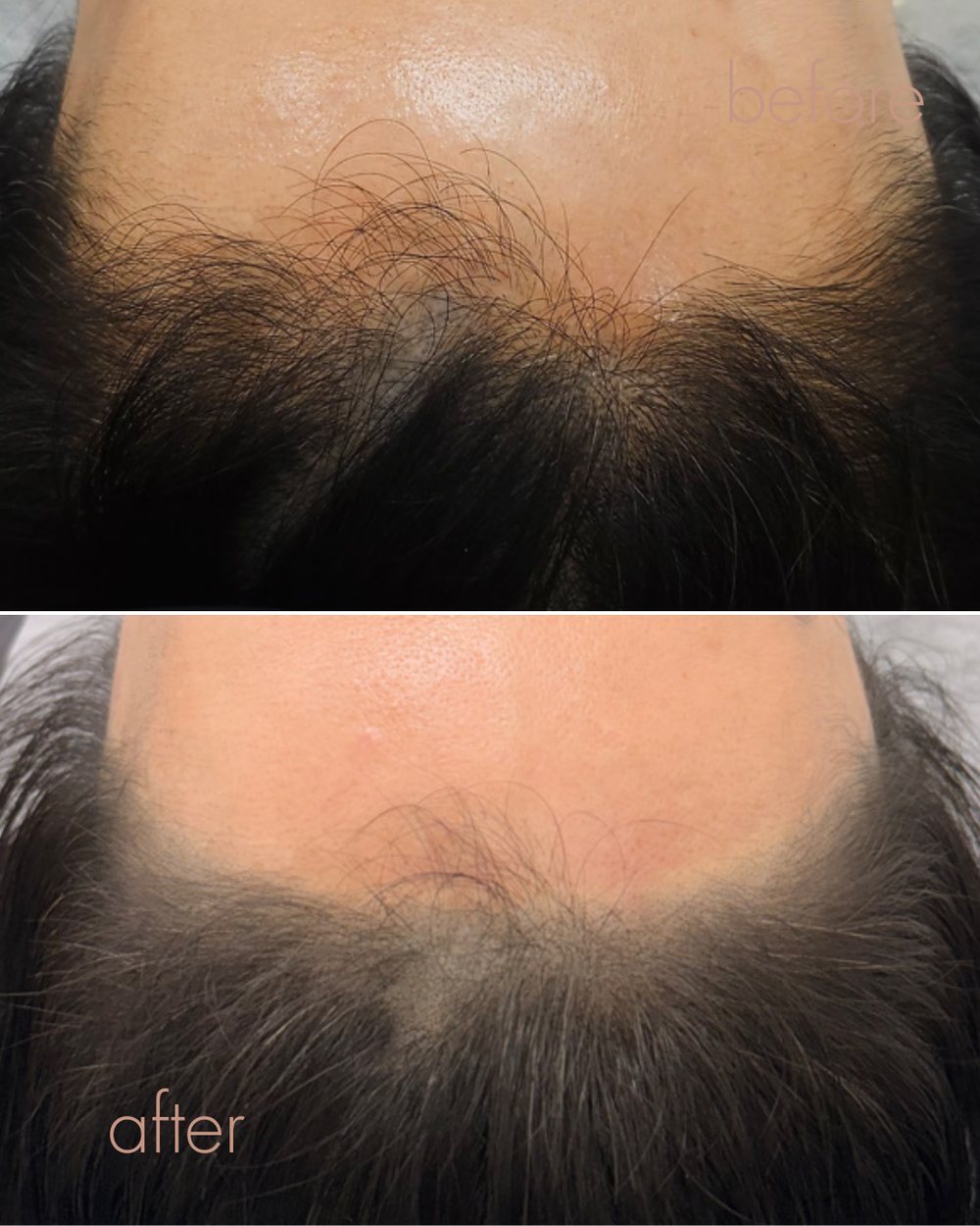 여성 헤어라인 두피문신 전후 결과 | 안양 평촌 D.LAB SCALP
