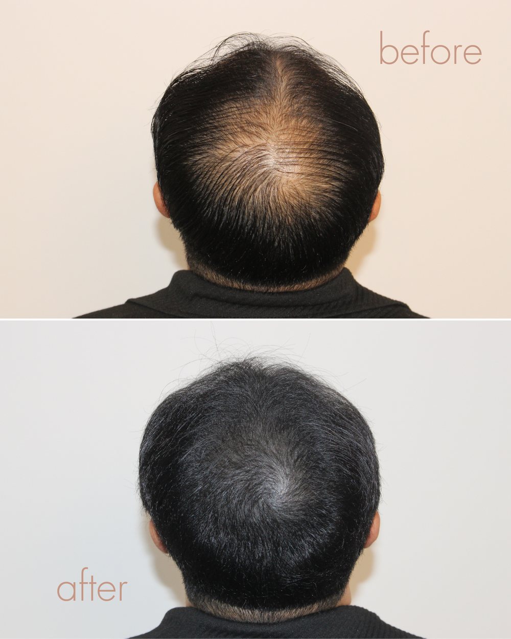 남성 정수리·가르마 두피문신 전후 결과 | 안양 평촌 D.LAB SCALP