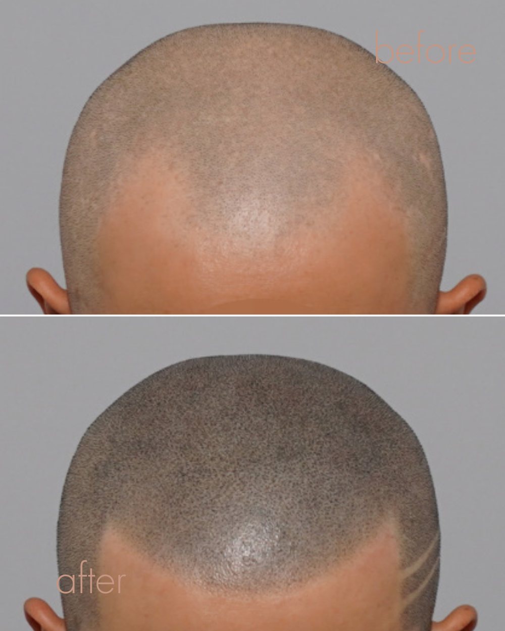 삭발형 두피문신 SMP 전후 결과 | 안양 평촌 D.LAB SCALP