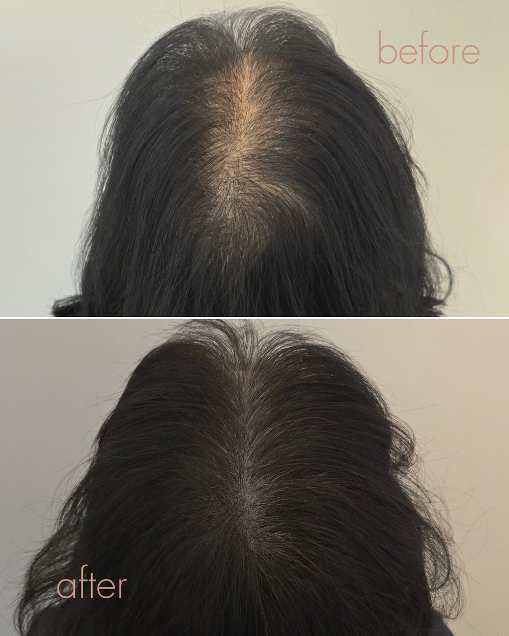 여성 가르마·정수리 두피문신 숱채움 전후 결과 | 안양 평촌 D.LAB SCALP